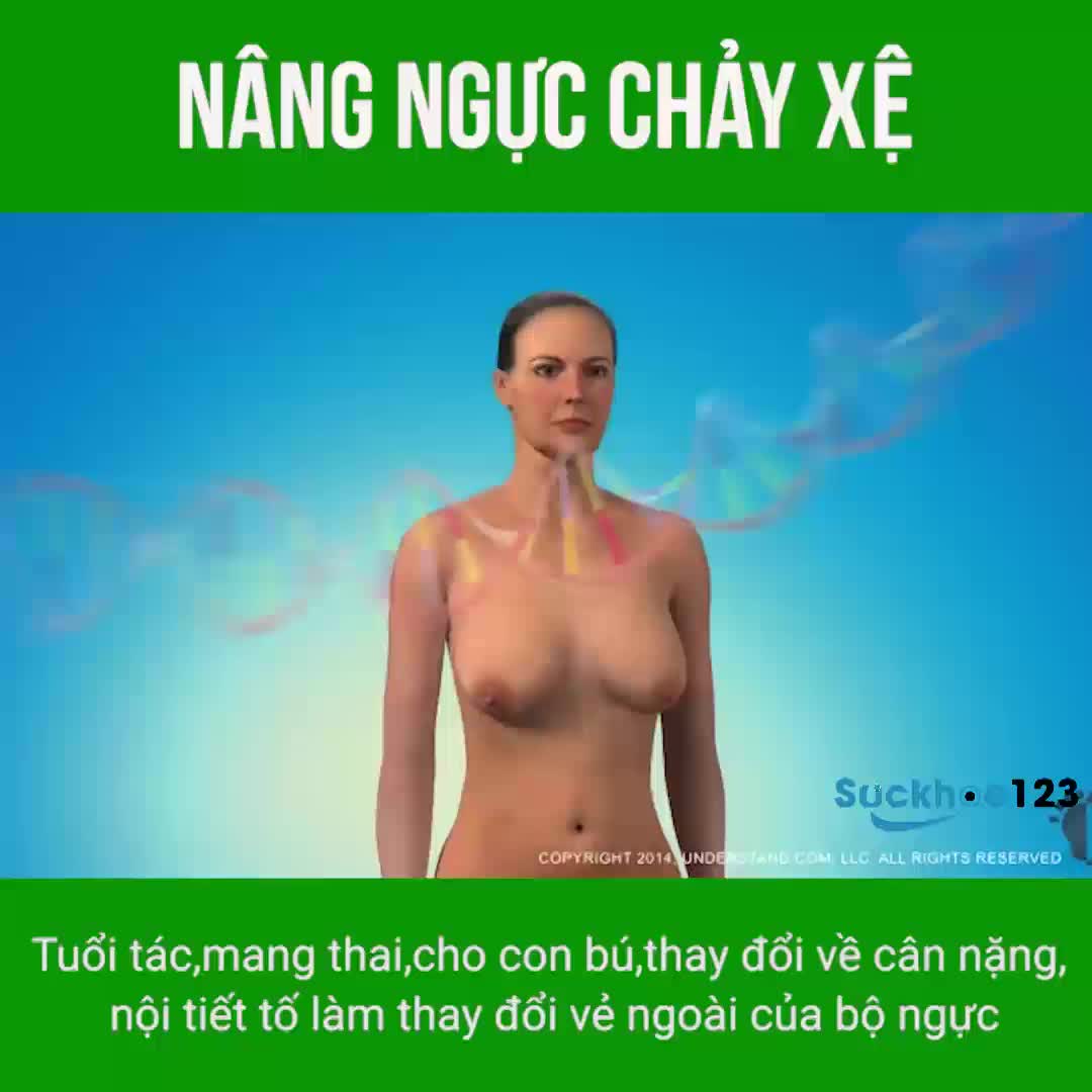 Nâng ngực chảy xệ