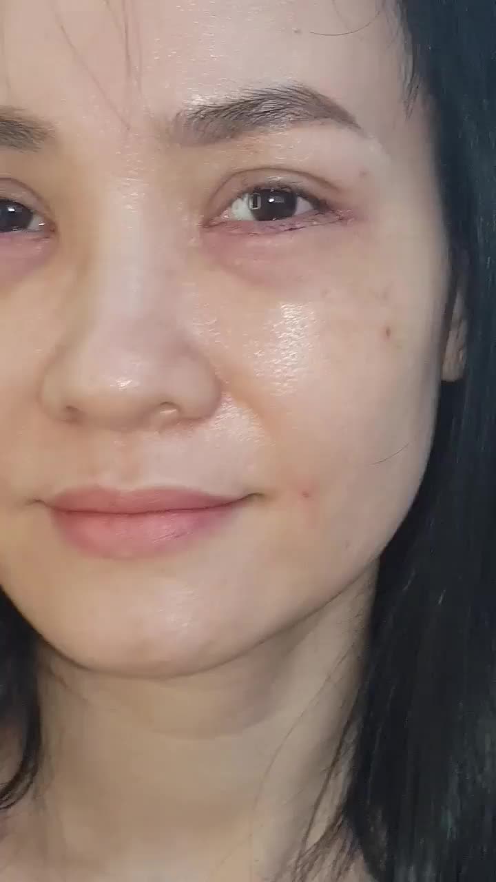 5 NGÀY TÁI KHÁM CẮT DA MI DƯỚI + CẤY MỠ TẾ BÀO GỐC XÓA THÂM QUẦNG MI DƯỚI