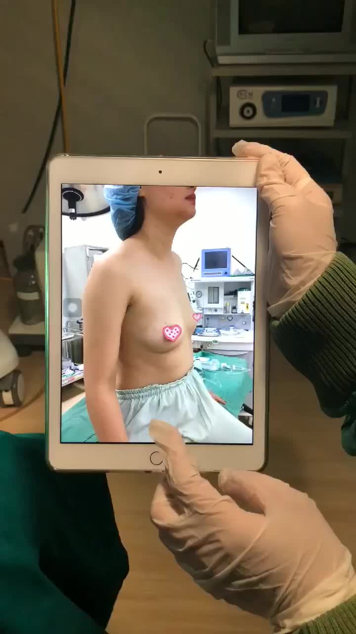 Ai bảo xương ức nhô là nâng ngực không đẹp?