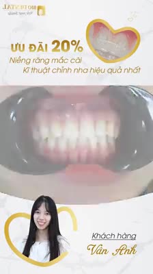 NIỀNG RĂNG THẨM MỸ VỚI MẮC CÀI SỨ TRONG SUỐT