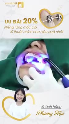 NIỀNG RĂNG MẮC CÀI - KĨ THUẬT CHỈNH NHA HIỆU QUẢ NHẤT !