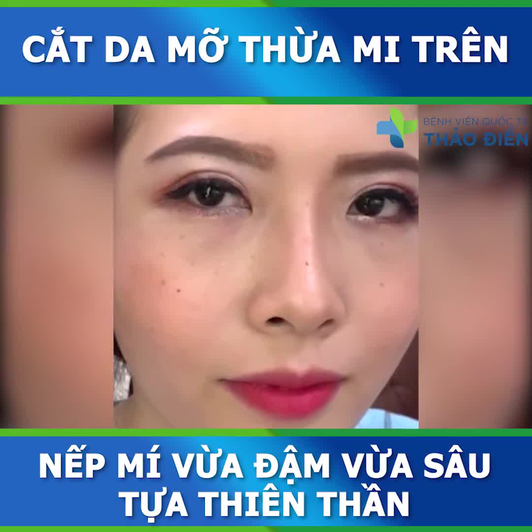 CẮT MÍ - Vừa nâng cấp thần thái, vừa giúp tỷ lệ giữa mắt và mũi thêm phần sắc nét, ấn tượng