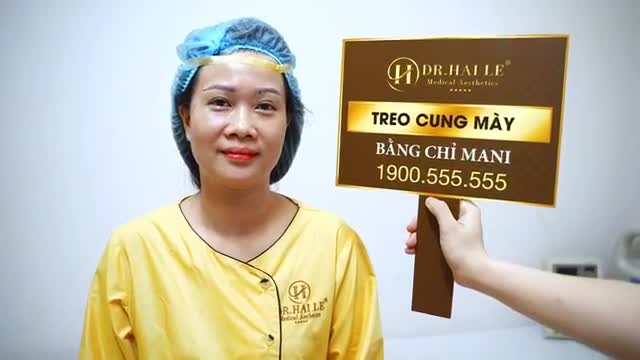 Chị Hương đến từ Hải Phòng trẻ ra 5-10 tuổi, khuôn mắt tươi trẻ rạng ngời hơn rất nhiều chỉ sau tiểu phẫu Nâng cung mày bằng chỉ Mani tại Dr.Hải Lê