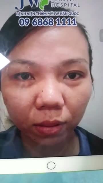 COMBO CẮT MẮT + NÂNG MŨI CẤU TRÚC S LINE ĐỂ "CHƠI LỄ 2-9" CHO NỮ KHÁCH HÀNG ĐẾN TỪ LONG AN