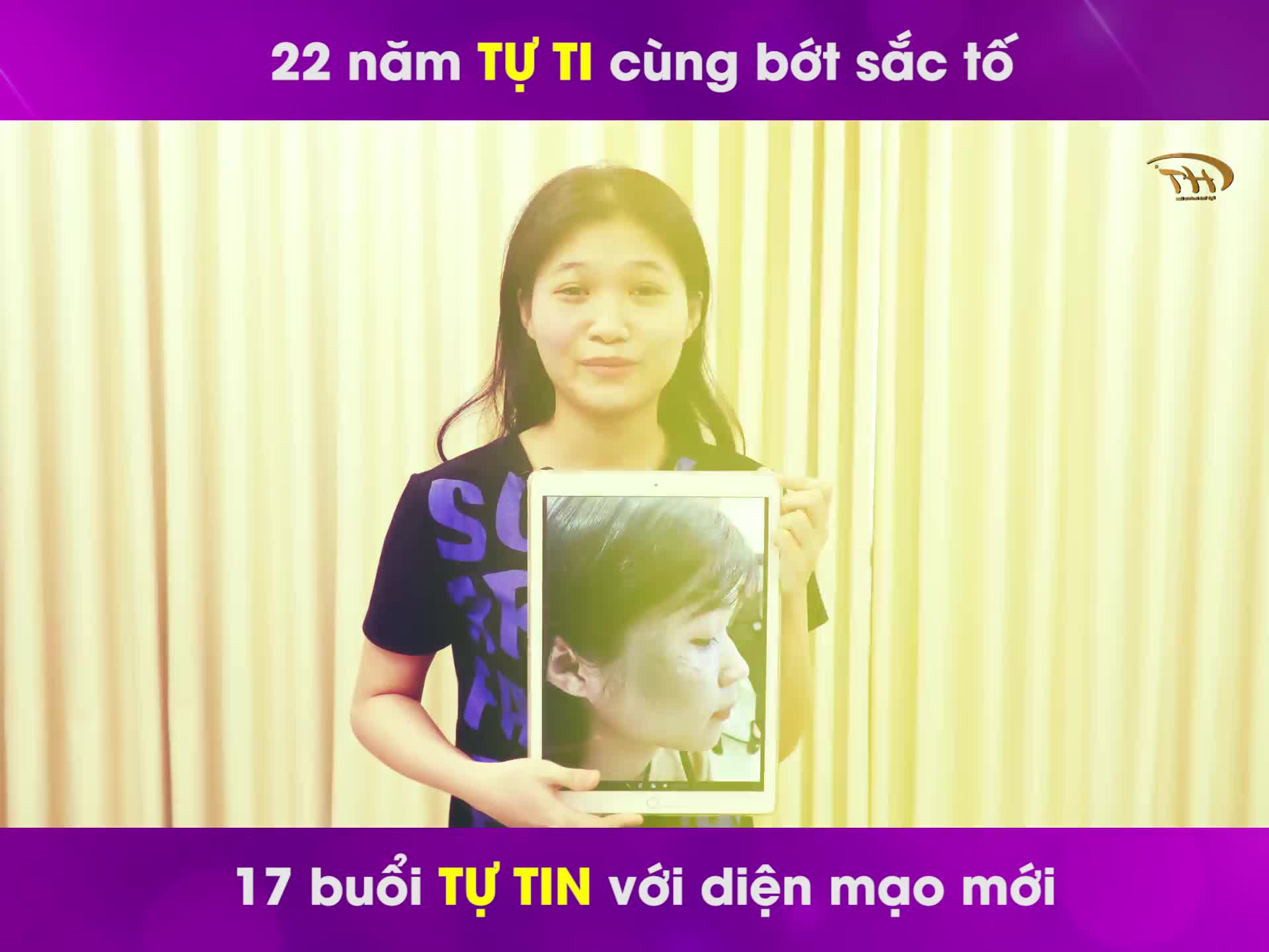 22 tuổi đồng nghĩa với 22 năm Hồng Nhung TỰ TI với khuôn mặt bị bớt sắc tố
