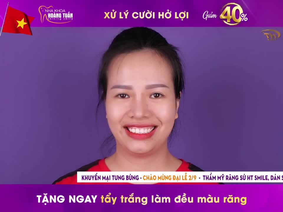 Điều trị cười hở lợi – Giải pháp cho nụ cười đẹp hoàn hảo