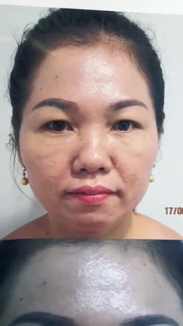 Trẻ hóa đôi mắt già nua đượm buồn bằng phương pháp lấy mỡ da thừa mí mắt.