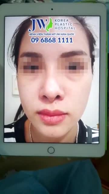 Giải cứu thành công chiếc mũi bị biến dạng của cô gái trẻ đã từng can thiệp dao kéo trước đó.