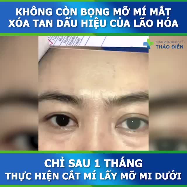 GIẢI PHÁP XÓA TAN MỠ THỪA + BỌNG MẮT