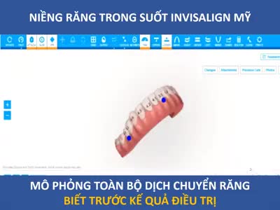 NIỀNG RĂNG TRONG SUỐT INVISALIGN MỸ - BIẾT TRƯỚC KẾT QUẢ SAU ĐIỀU TRỊ.