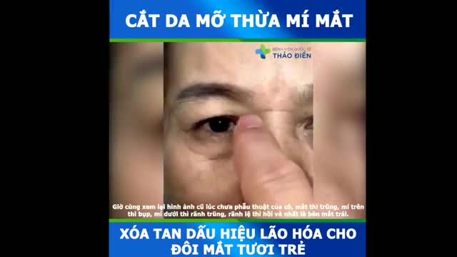 Khách hàng tái khám sau “CẮT DA MỠ THỪA MI TRÊN, MI DƯỚI + TẠO MÍ” - Bật nét trẻ trung qua đôi mắt linh hoạt không tì vết