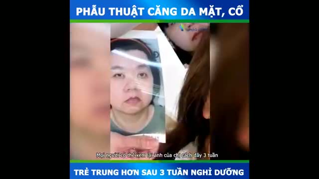Khách Việt Kiều rũ bỏ hoàn toàn khuyết điểm má chảy xệ, cằm ngắn, mắt sụp sau 3 tuần thực hiện CĂNG DA MẶT