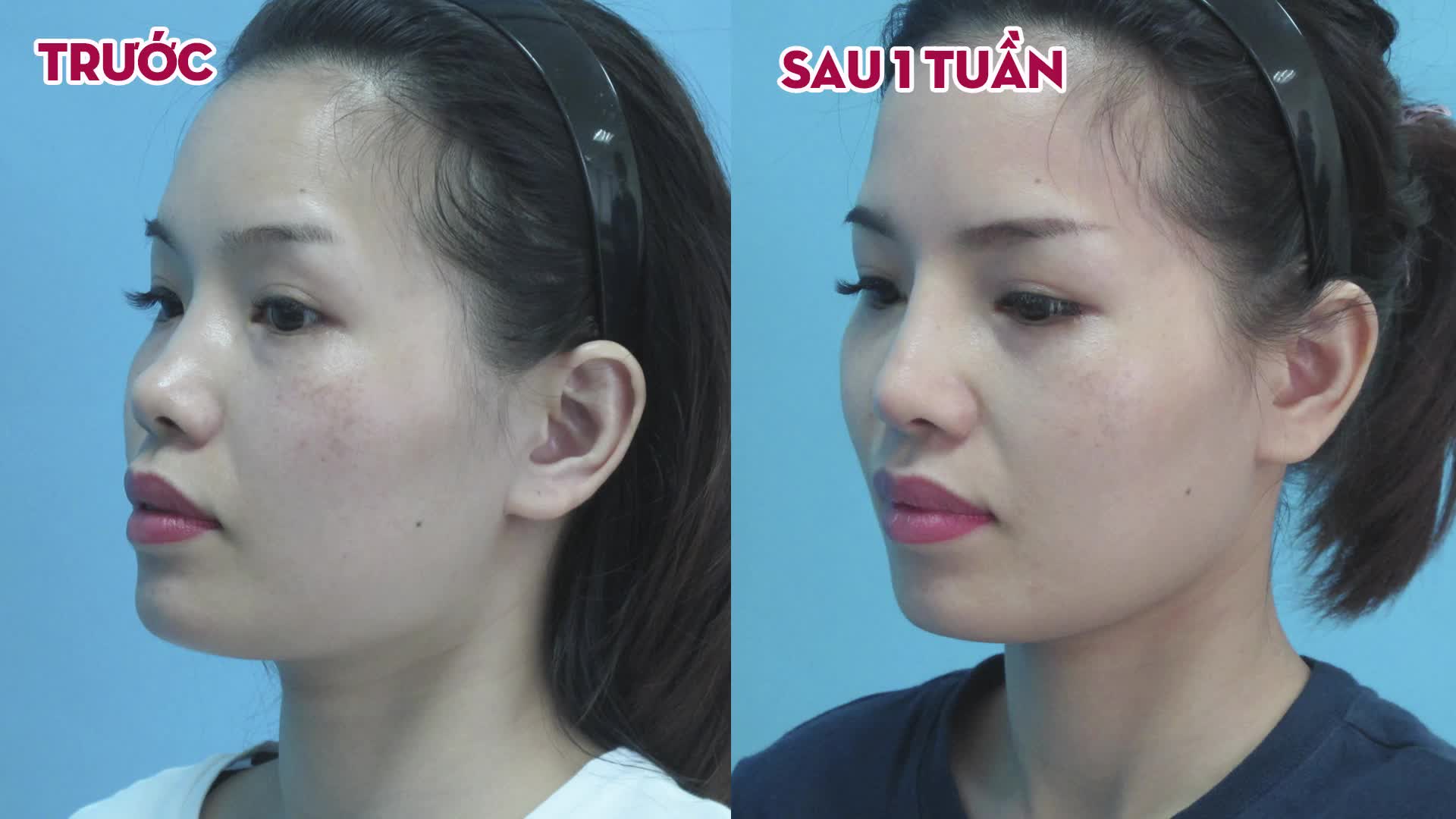 LỰA CHỌN DÁNG MŨI NHƯ THẾ NÀO CHO PHÙ HỢP?