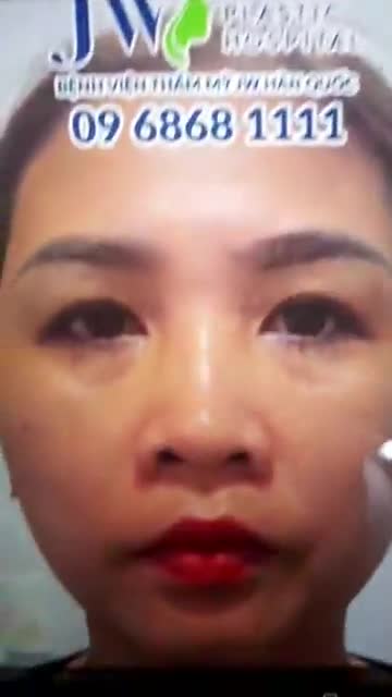 Mắt sáng nếp mí mềm mại và đều nhau chỉ sau 60 phút lấy mỡ da thừa mí mắt tại Bệnh viện JW.