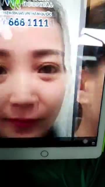 Kết quả nâng mũi cấu trúc Sline tại bệnh viện Thẩm mỹ JW Hàn Quốc