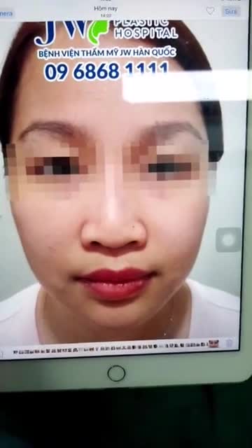 Trực tiếp một ca phẫu thuật nâng mũi cấu trúc S Line tại Bệnh viện JW.