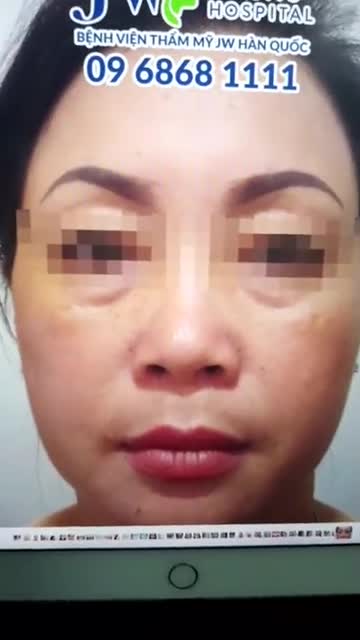 Kết quả sau khi kéo dài đầu mũi kết hợp dựng trụ sụn tự thân bằng phương pháp nâng mũi cấu trúc S Line tại Bệnh viện JW.