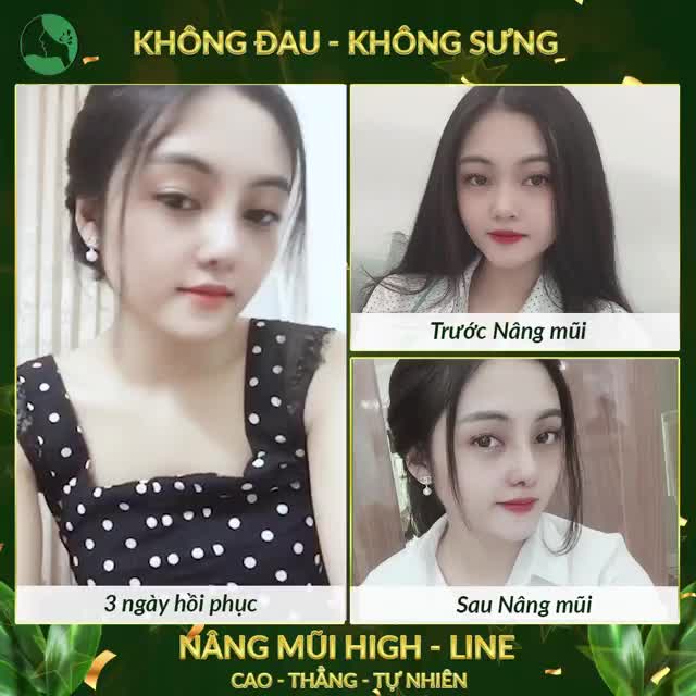 Nâng tầm nhan sắc chỉ 12 TRIỆU với NÂNG MŨI HIGH LINE | Cho dáng mũi cao sang, tự tin SELFIE mọi góc độ.