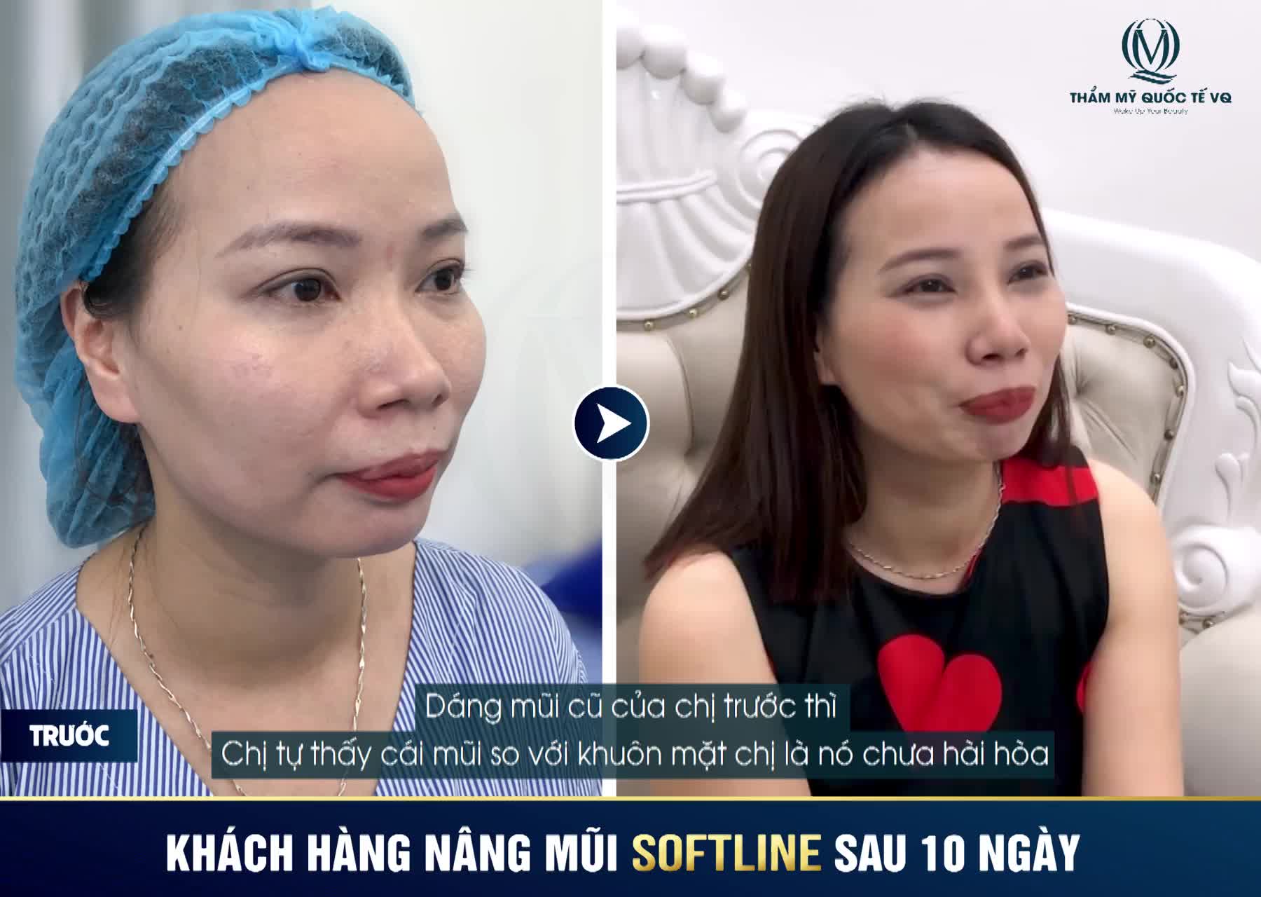 ĐẸP XUẤT SẮC VỚI NÂNG MŨI SOFTLINE
