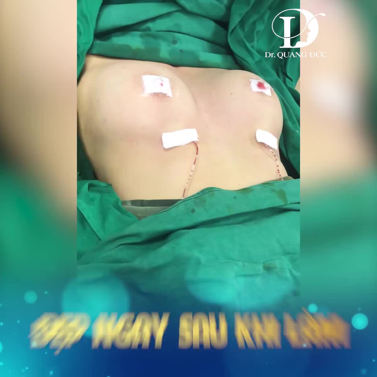 NÂNG NGỰC AN TOÀN - ĐẸP NGAY SAU LÀM