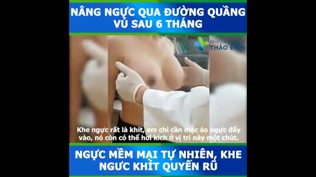 [KH TÁI KHÁM: SAU 6 THÁNG NÂNG_NGỰC QUA ĐƯỜNG QUẦNG]