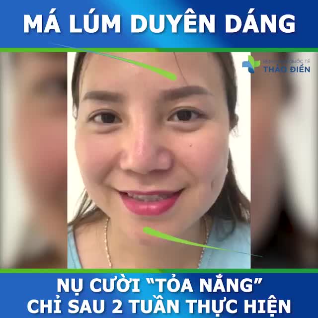 NỤ CƯỜI TỎA NẮNG TRẮNG XÓA MÀN HÌNH SAU 2 TUẦN TẠO MÁ LÚM