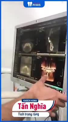 KHÔI PHỤC RĂNG MẤT VỚI TRỒNG RĂNG IMPLANT CHỈ SAU 7 NGÀY
