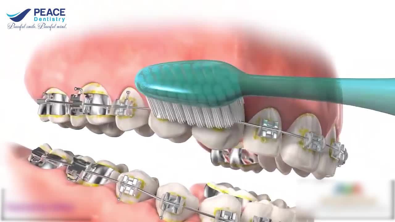 VỆ SINH RĂNG MIỆNG ĐÚNG CÁCH KHI NIỀNG RĂNG