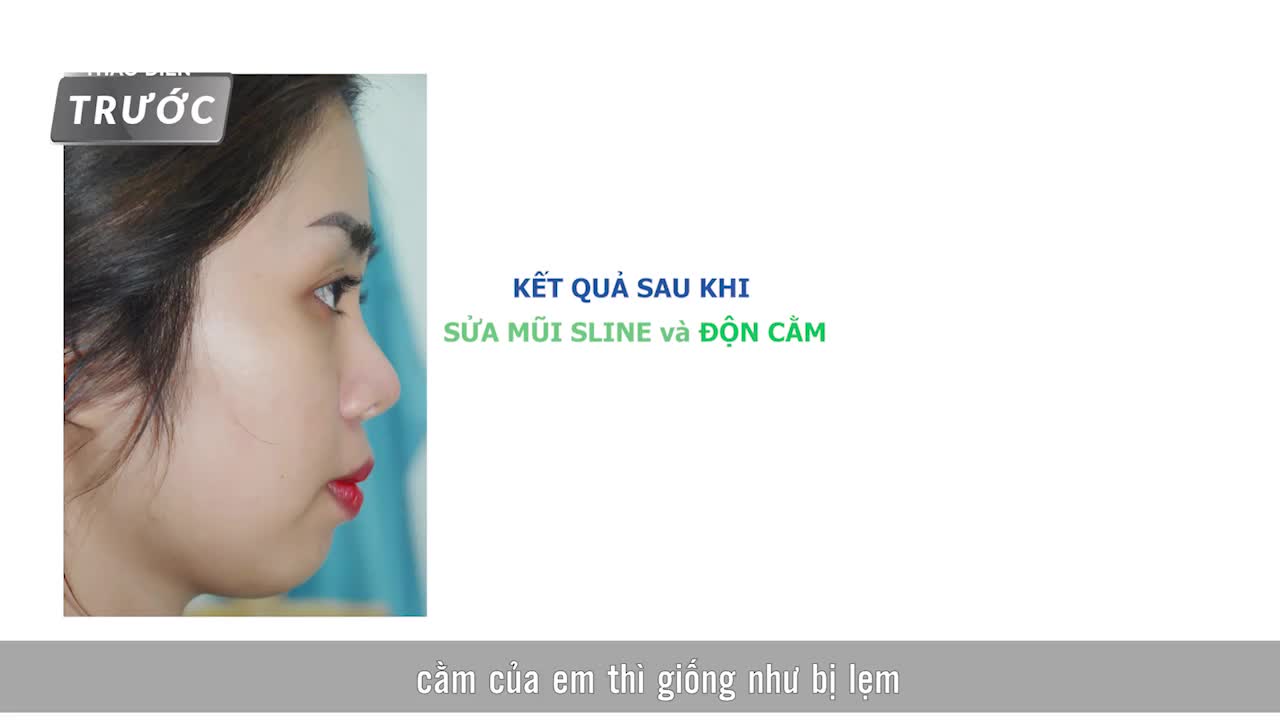 PHỎNG VẤN KH SAU SỬA LẠI MŨI + ĐỘN CẰM