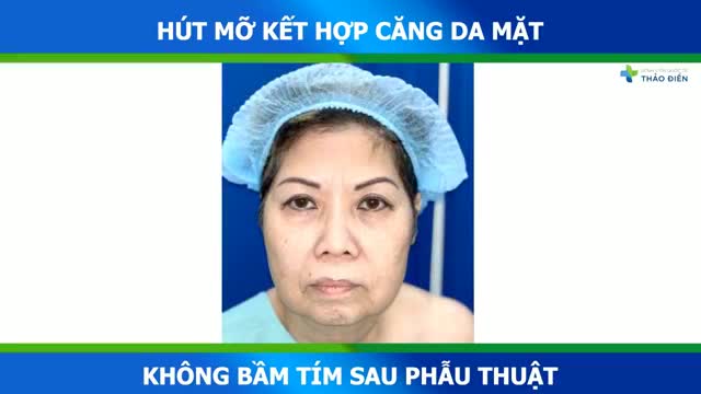 [LIVESTREAM: QUY TRÌNH CĂNG DA MẶT] ĐẸP NHƯNG KHÔNG ĐAU - TRẺ HÓA TOÀN DIỆN