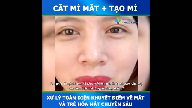 khách hàng chia sẻ sau 30 ngày Cắt mí
