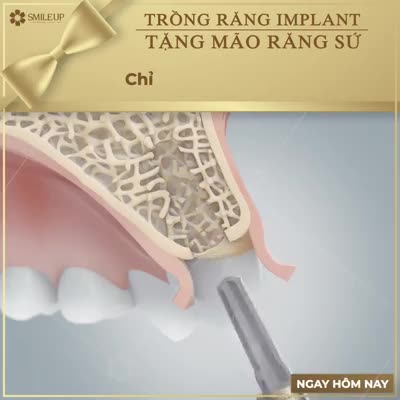 TRỒNG RĂNG IMPLANT THAY THẾ RĂNG ĐÃ MẤT CHỈ 7TR9