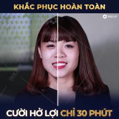SMILE UP KHẮC PHỤC HOÀN TOÀN CƯỜI HỞ LỢI CHỈ 30 PHÚT