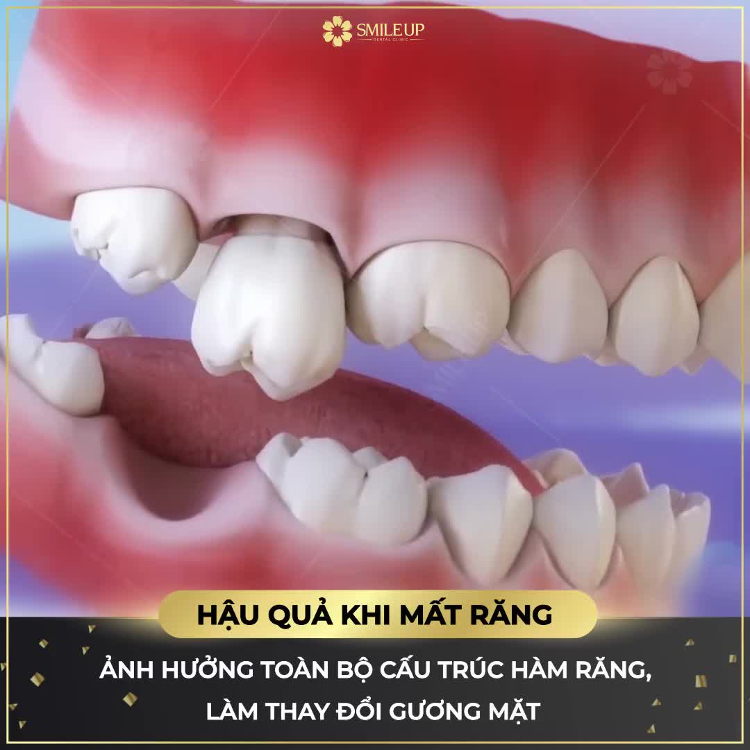 RĂNG ĐI ĐỂ LẠI MUÔN VÀN NỖI LO