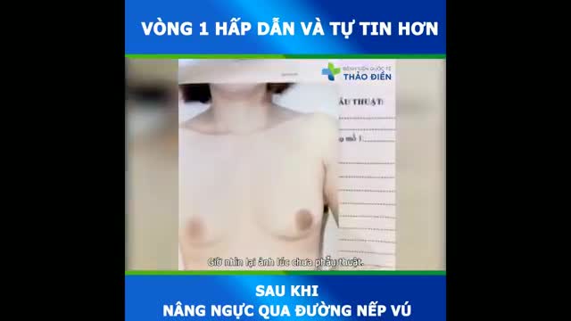 [Nhật ký khách hàng – Tái khám sau 6 tháng đặt túi 275cc qua đường nếp vú]