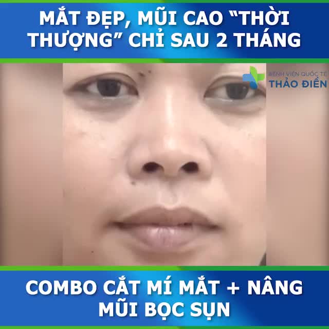 Thay đổi tổng quan 180° sau Combo thần thái: CẮT MÍ MẮT + NÂNG MŨI BỌC SỤN