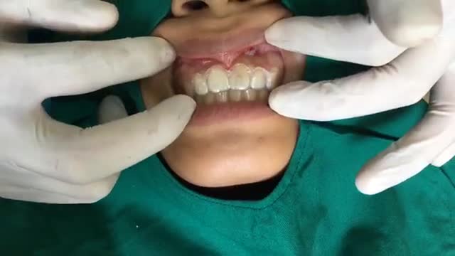 Trực tiếp phẫu thuật cười hở lợi cho bạn gái đến từ Bắc Giang.
Bác sĩ thực hiện: Lê Sơn Tùng