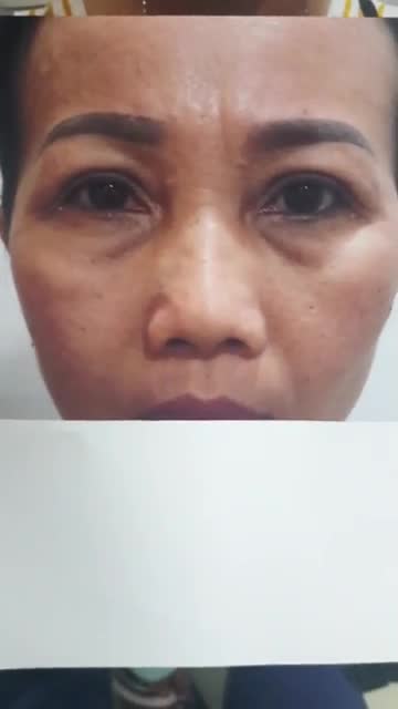 Trẻ hóa đôi mắt già nua kết hợp nâng cơ, làm mờ rãnh mũi má bằng phương pháp MIDFACE 3 IN 1 độc quyền tại Bệnh viện JW.