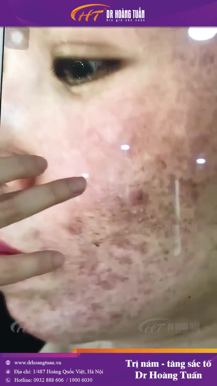 Xuất Sắc! Kết quả điều trị nám và tăng sắc tố sau viêm của các bác sĩ, ktv phòng Laser