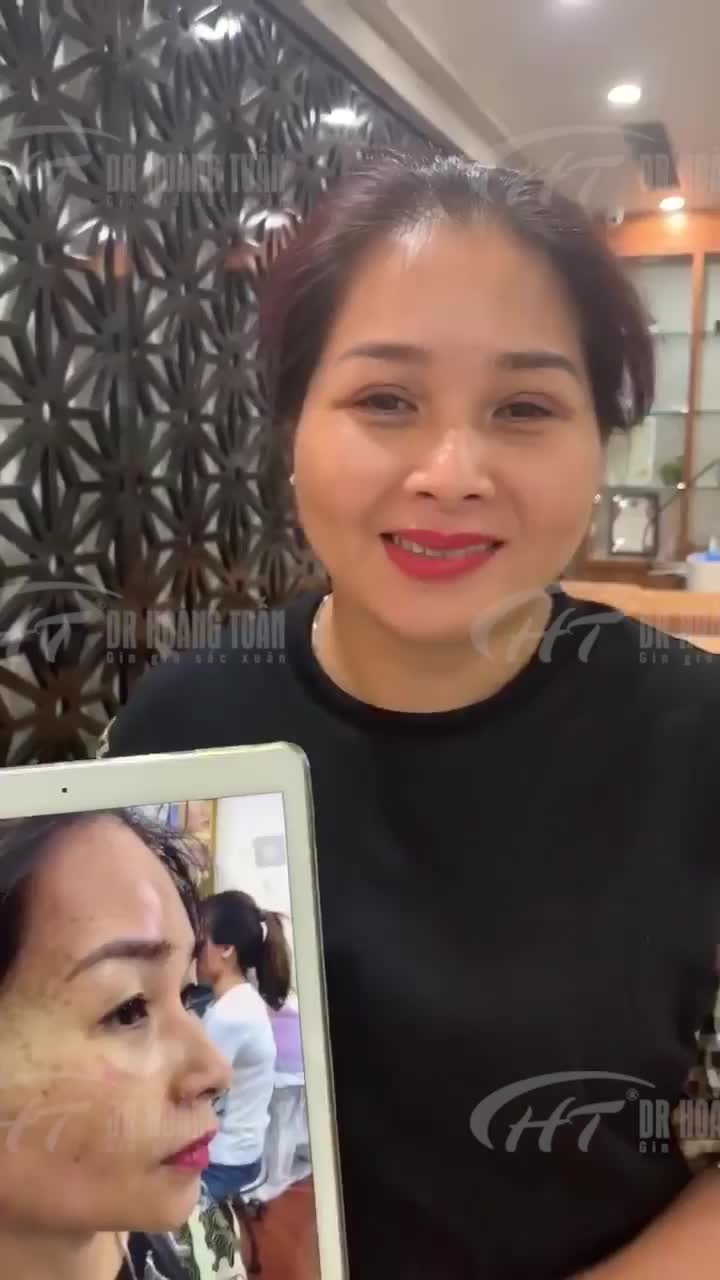 Nụ cười hài lòng của chị khách hàng sau khi trị nám thành công - 2 năm không tái phát