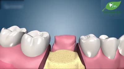 NGUY HIỂM] HẬU QUẢ DO MẤT RĂNG LÂU NGÀY