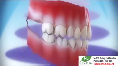 [NGUY HIỂM] HẬU QUẢ DO MẤT RĂNG LÂU NGÀY