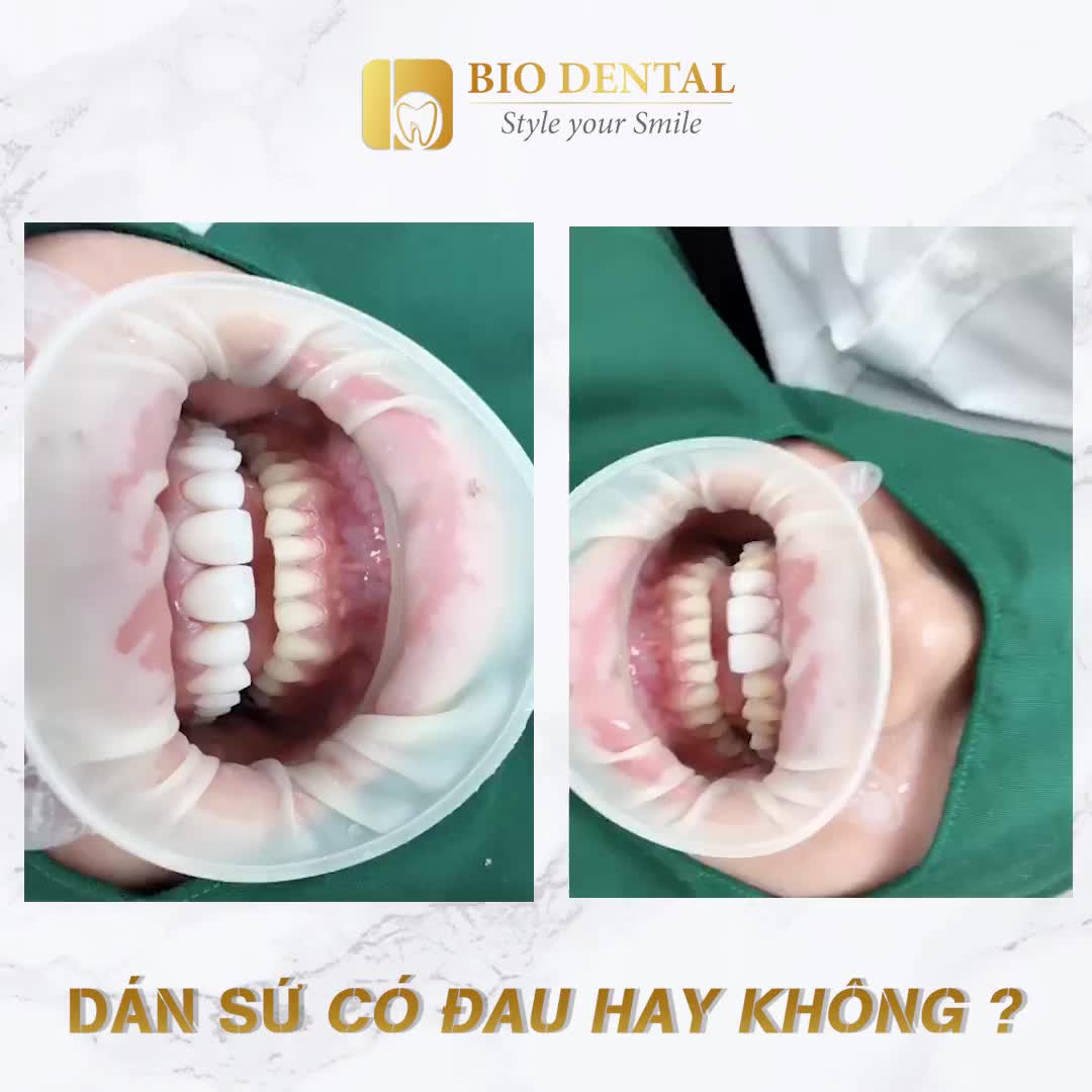 DÁN SỨ CÓ ĐAU HAY KHÔNG