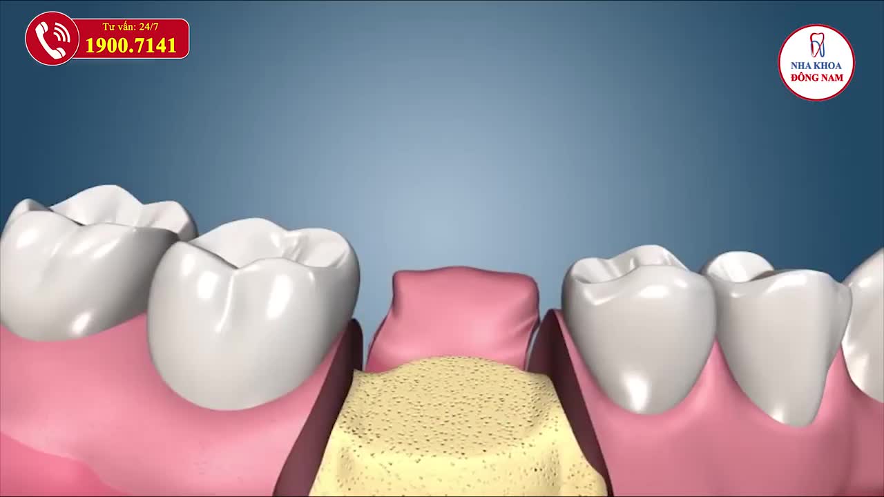 5️⃣ THÔNG TIN BẠN CẦN BIẾT ĐỂ TRỒNG RĂNG IMPLANT VỚI GIÁ SIÊU TIẾT KIỆM TẠI NHA KHOA ĐÔNG NAM