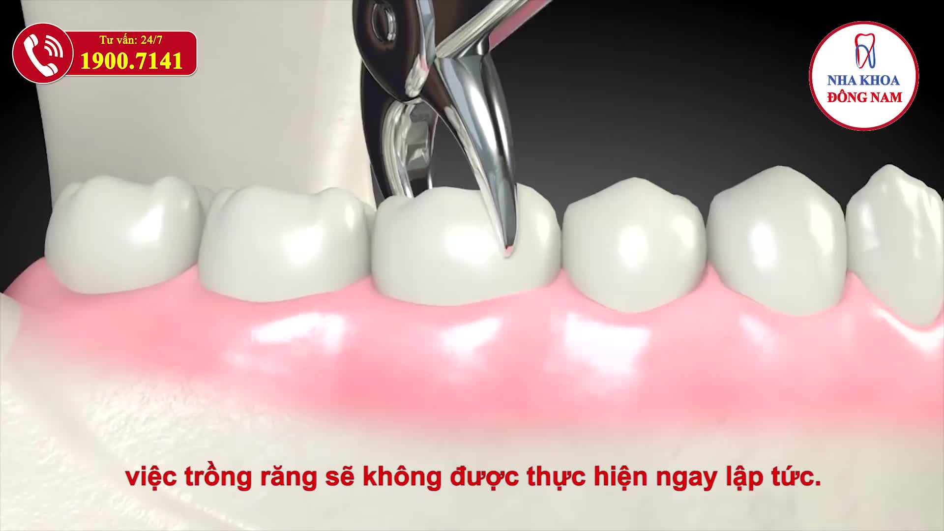 TRỒNG RĂNG IMPLANT TIẾT KIỆM - HỖ TRỢ CẤY GHÉP XƯƠNG MIỄN PHÍ TẠI NHA KHOA ĐÔNG NAM
