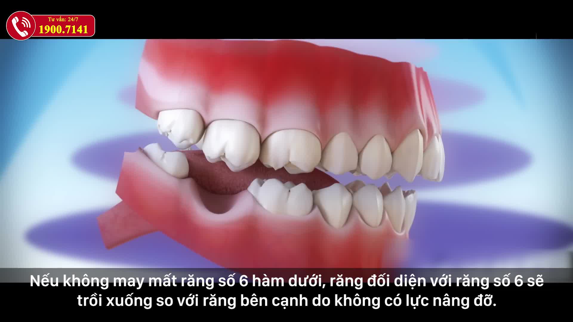 MẤT RĂNG SỐ 6 NGUY HIỂM HƠN TA NGHĨ