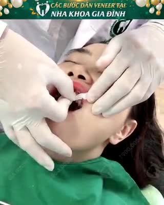 DÁN SỨ VENEER ULTRATHIN 100% KHÔNG MÀI NHỎ