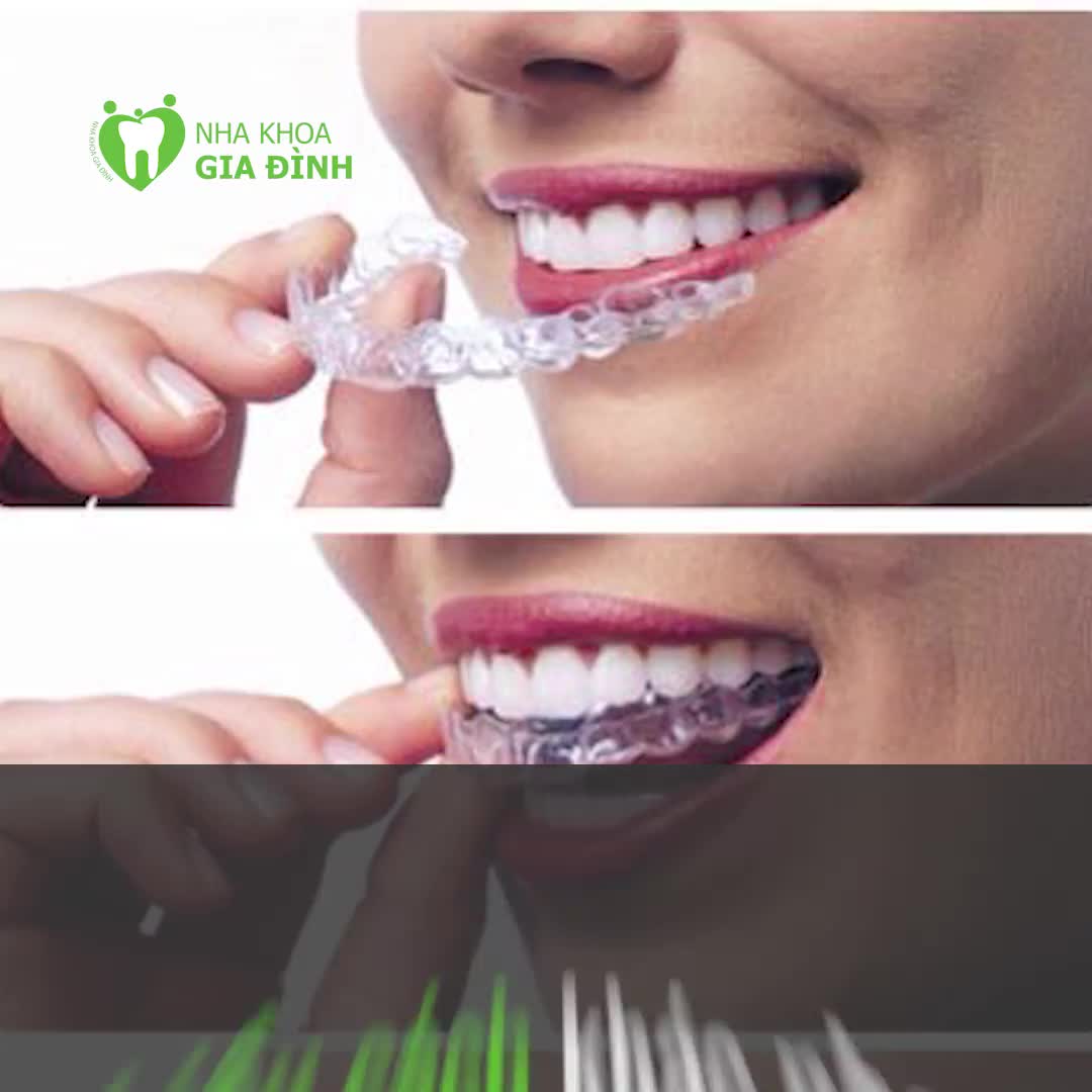 CÁC CÁCH TẨY TRẮNG RĂNG HIỆU QUẢ
TỰ TIN HƠN VỚI HÀM RĂNG TRẮNG SÁNG