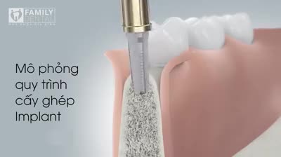 MÔ PHỎNG CẤY GHÉP IMPLANT TẠI NHA KHOA GIA ĐÌNH