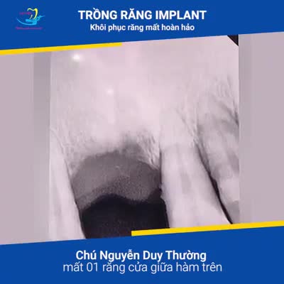 KẾT QUẢ TRỒNG RĂNG CỬA đã mất cách đây 3 năm của chú Nguyễn Duy Thường (55 tuổi, Hà Nội).